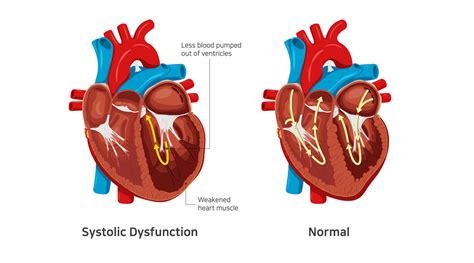 left ventricular systolic dysfunction